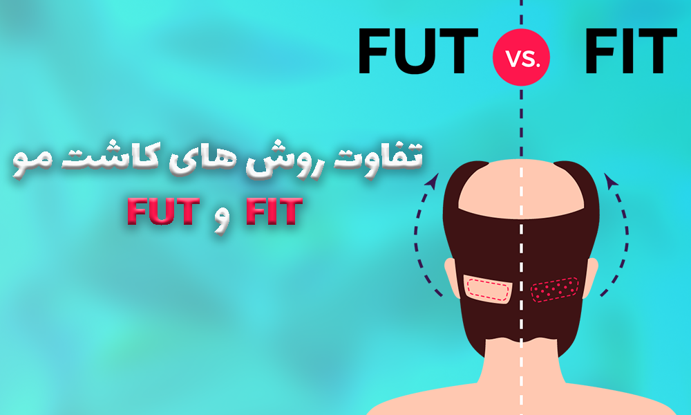 تفاوت روش کاشت مو  FIT و FUT